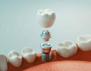 cosmetic dentistry treatments , dental implant, stages, mock image, education