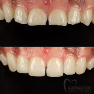 composite bonding, smile makeover, improved smile
