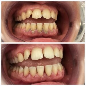 before and after hygienist dental