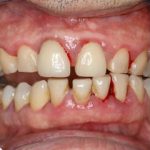 Dartford Hygienist Scale and polish gum disease